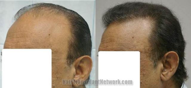 Left view - Before and after hair transplantation photos