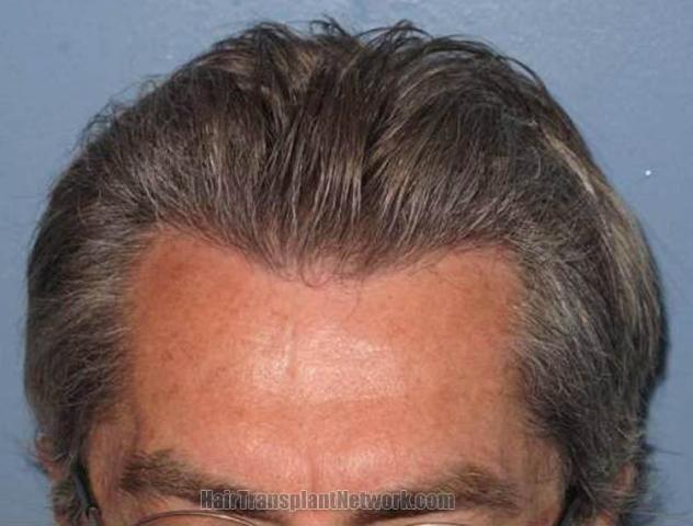 Closeup front view photo of hairline 6 months postoperative