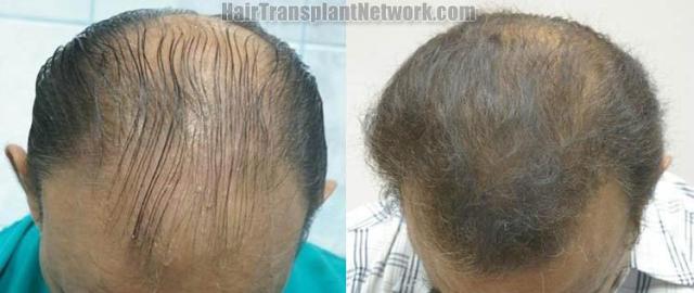 Before and after hair transplantation images