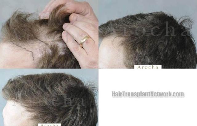 Hair restoration procedure before and after results