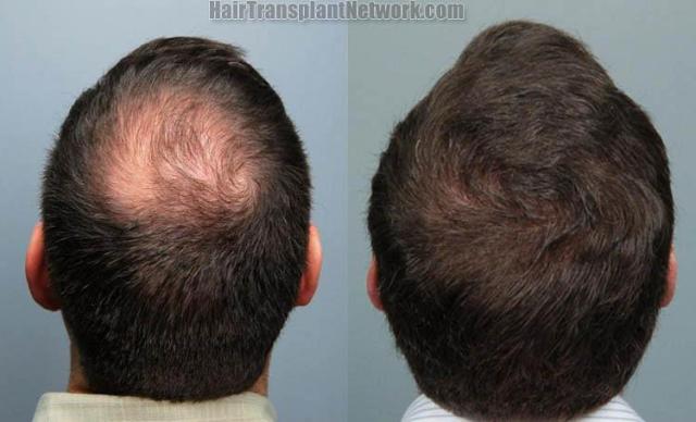 Surgical hair transplantation result photographs