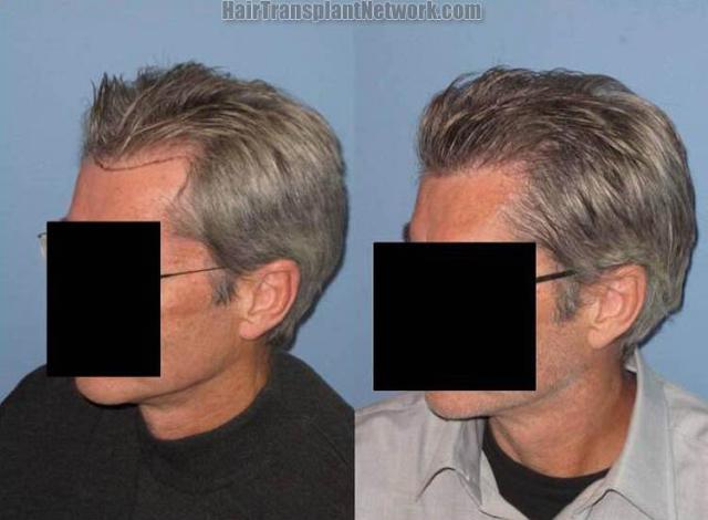 Hair restoration procedure before and postoperative image