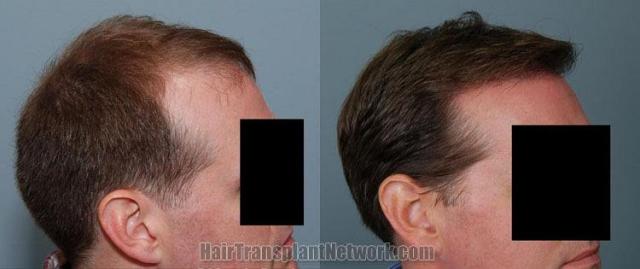 Right view before and after hair transplantation surgery