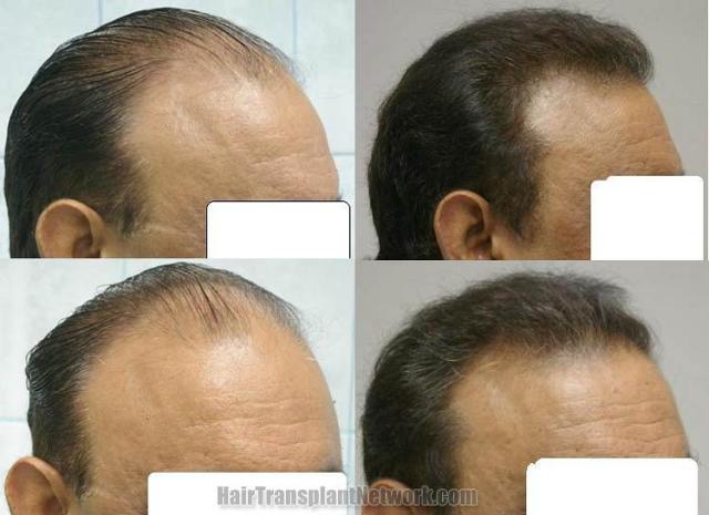 Hair transplantation before and after photographs