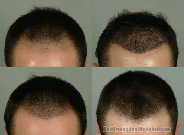 Tilt down view before and after hair restoration pictures