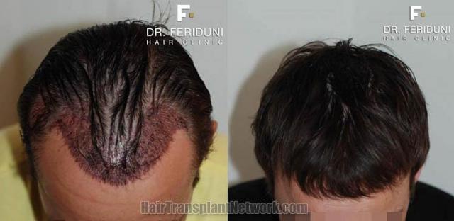 Top view - Before and after hair transplantation surgery