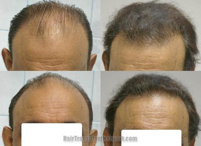 Front view - Before and after hair transplantation