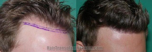 Right view - Before and after surgical hair restoration