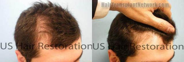 Hair replacement surgery result images before and after