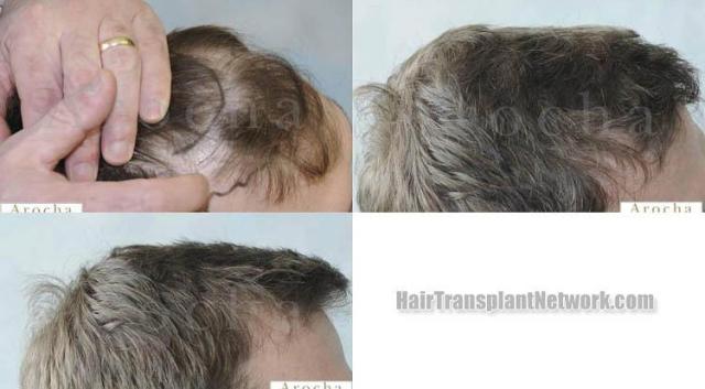 Before and after hair transplantation result photographs