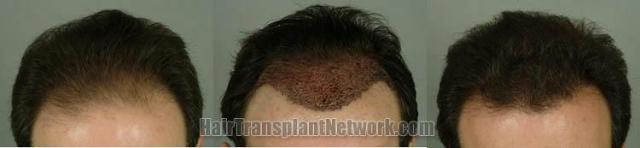 Hair restoration surgical result pictures