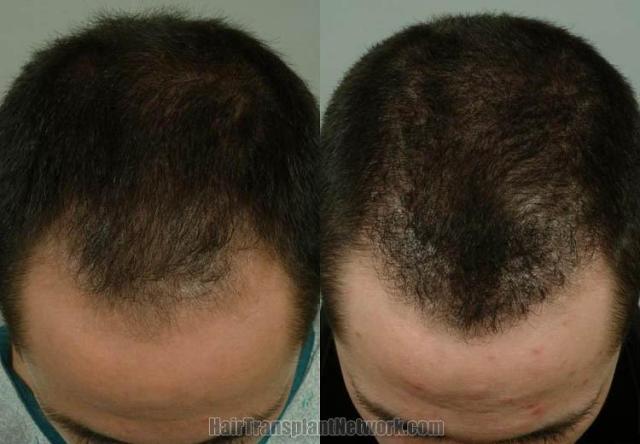 Top view before and after hair transplant procedure 