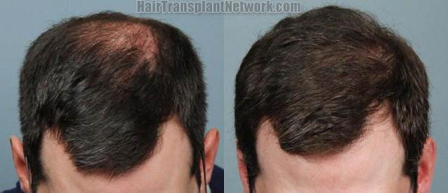 Top view - Before and after surgical hair replacement