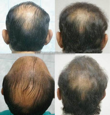 Hair restoration procedure images with Finasteride