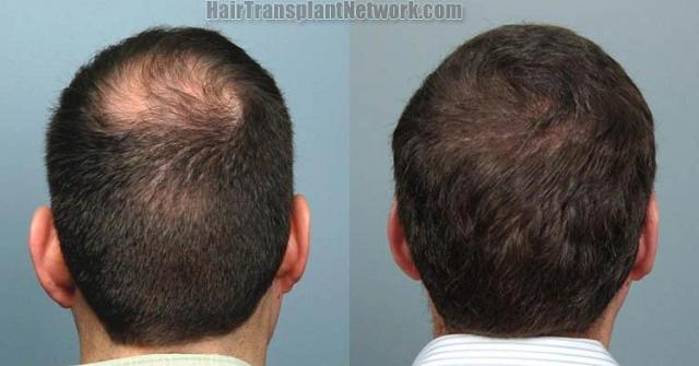 Hair replacement surgery before and after images