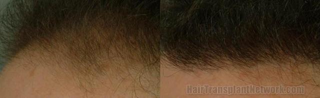 Close ups of hairlines before and after hair transplant