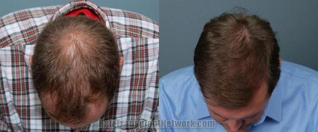 Top view before and after photos from hair transplant