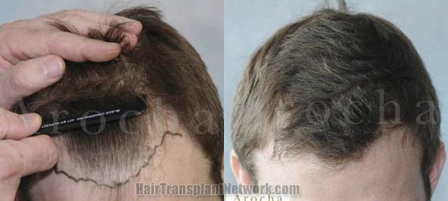 Before and after hair transplant procedure images