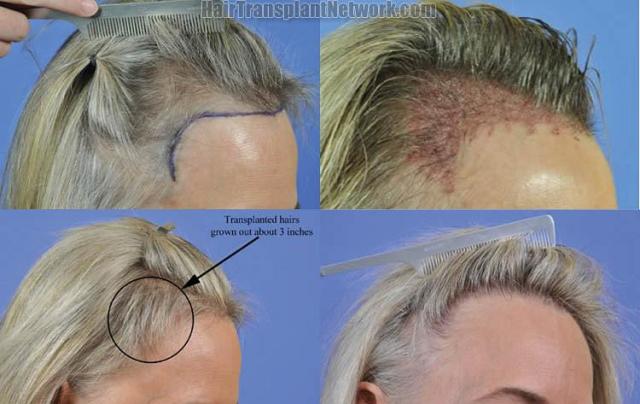 Right view before and after hair transplant procedure