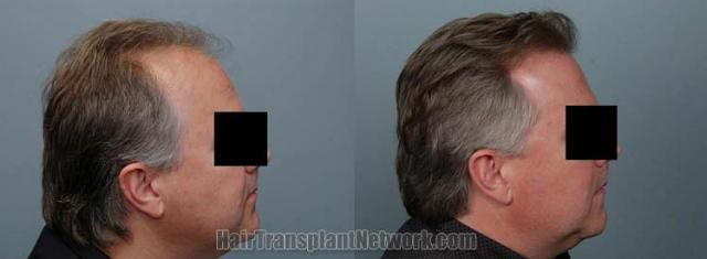 Right view before and after hair transplantation images