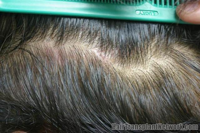 Residual scar postoperative from hair transplantation