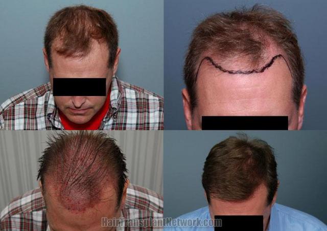 Tilt down view before and after hair restoration pictures