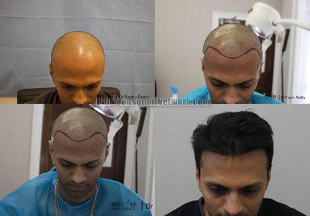 Hair transplantation surgery before and after photos