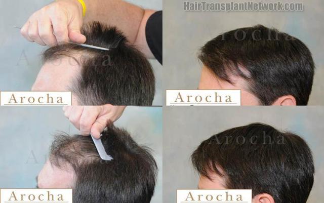 Left view - Before and after hair transplantation images