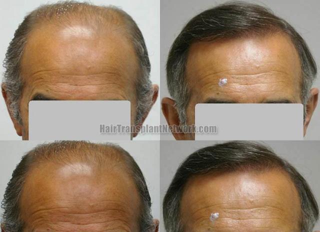 Front view before and after hair restoration photos