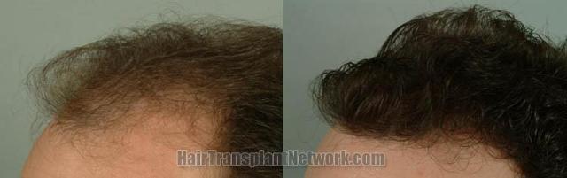 Hair transplantation surgery result images