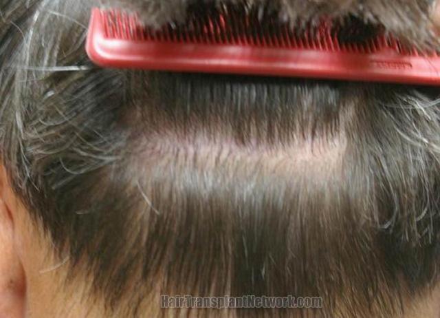 Residual scar one year after hair transplant surgery