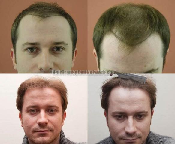 Hair transplantation surgery before and after pictures