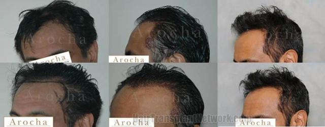 Hair transplant procedure left view before and after images