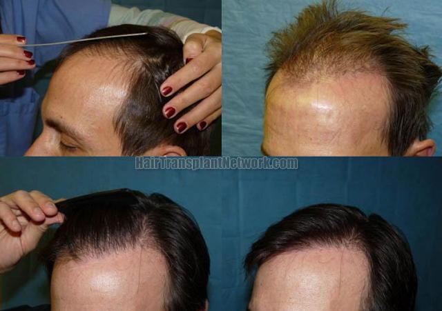 Left view before and after hair transplantation images