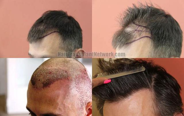 Hair transplantation surgery before and after photos