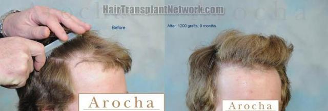 Hair transplantation surgery before and after images