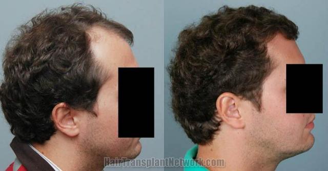 Hair transplantation surgery before and after photos