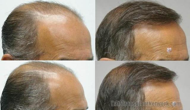 Hair transplant procedure before and after photos