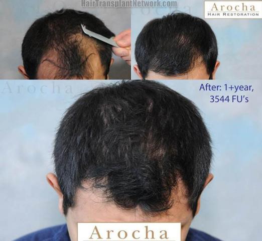 Hair transplantation surgery before and after photos