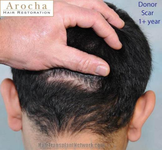 Hair transplantation surgery before and after pictures