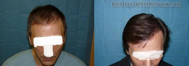 Top view - before and after hair transplantation images