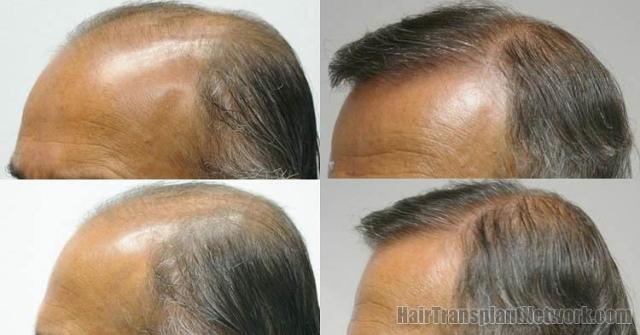 Left view before and after hair restoration images