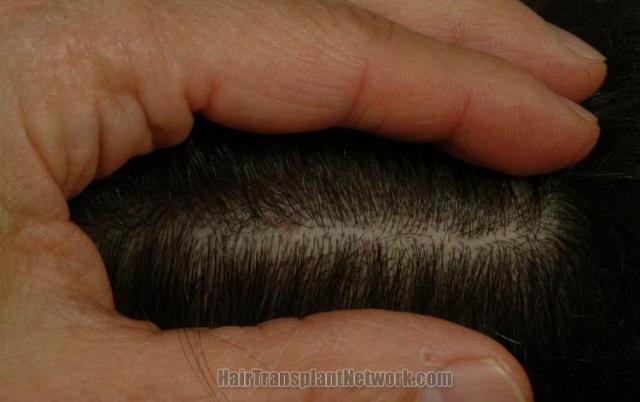 Residual scar eight months after hair restoration procedure