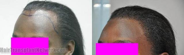 Left view before and after hair restoration procedure