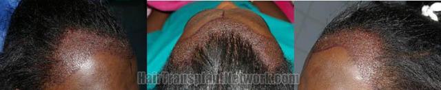 Immediate postoperative hair transplant images