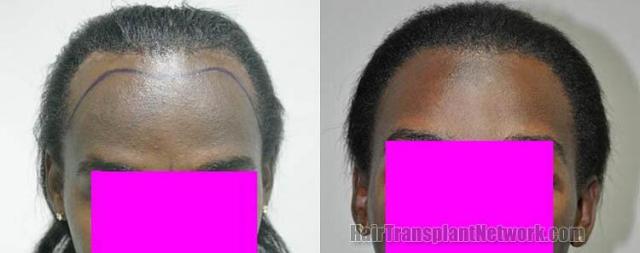 Before and after  - African female