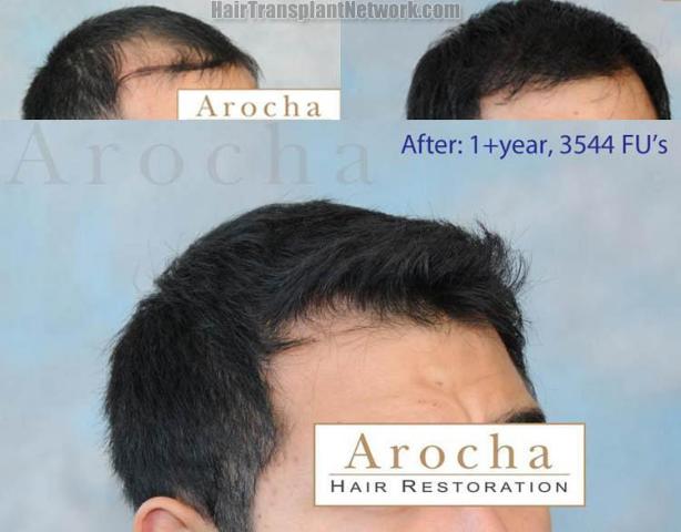 Hair transplantation surgery before and after images