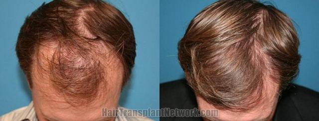 Before and after hair restoration pictures