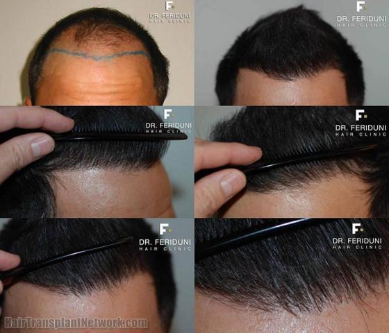 Hair restoration procedure results