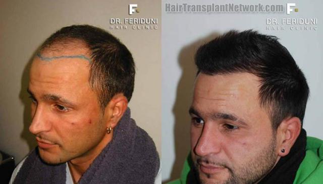 Left view before and after hair transplant procedure